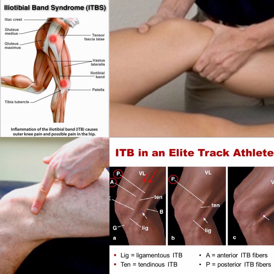 Physiotherapy in Ottawa Area for Knee - Iliotibial Band Syndrome