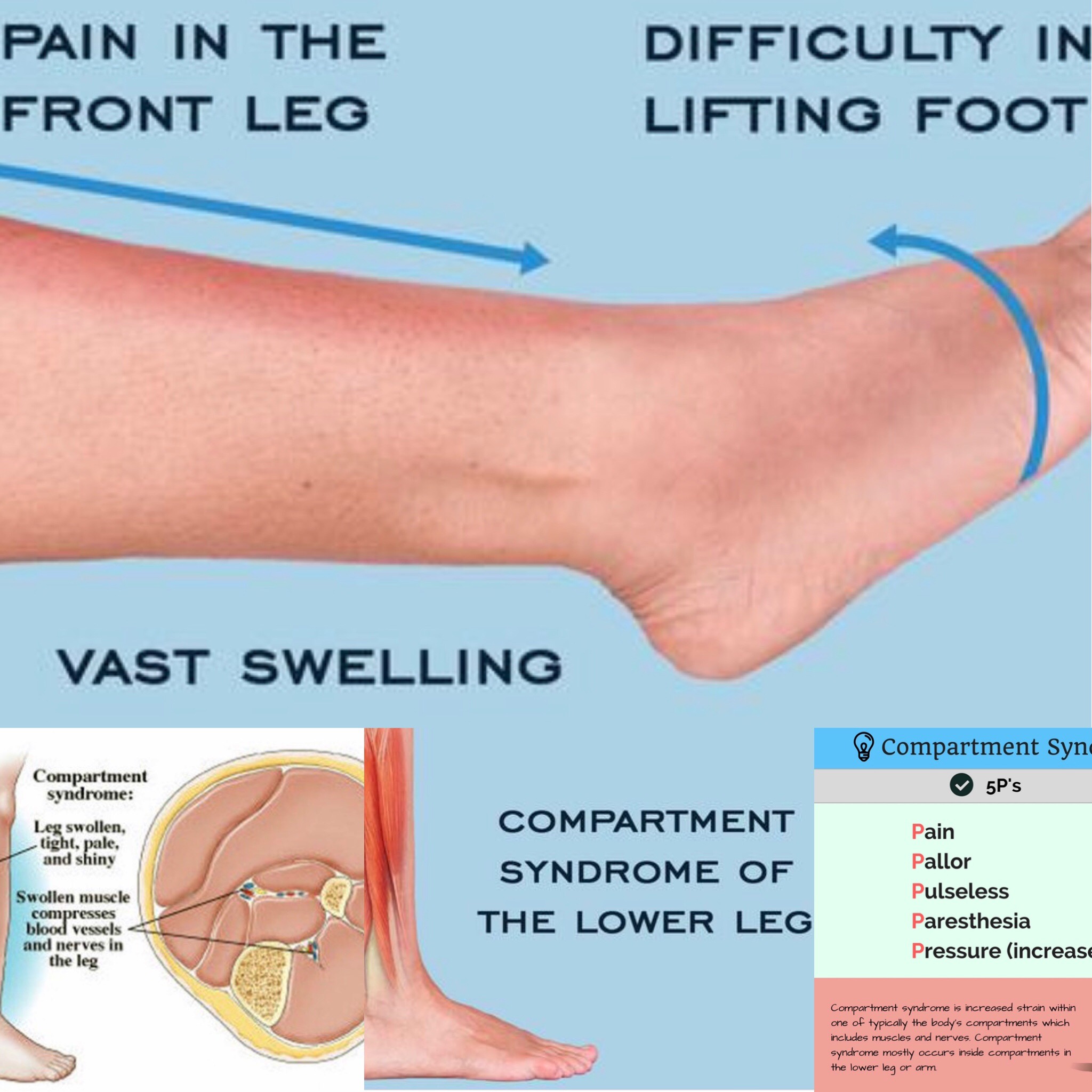 Shin Splints Kinesio Taping Posterior Compartment Syndrome