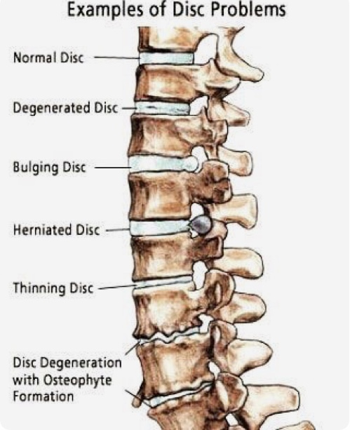 modificari degenerative disco vertebrale