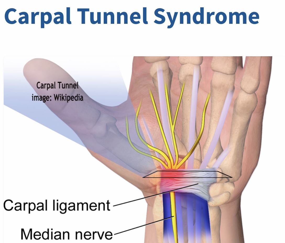Carpal Tunnel Syndrome, Enzo Pierro