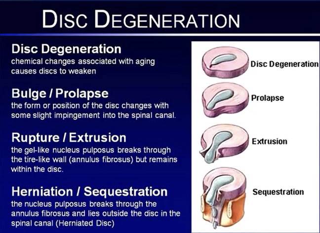 Cervical Disk Herniation