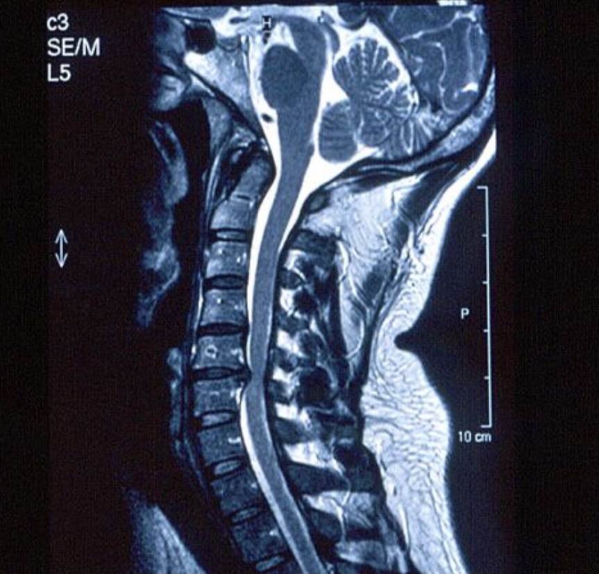 Cervical Disk Herniation